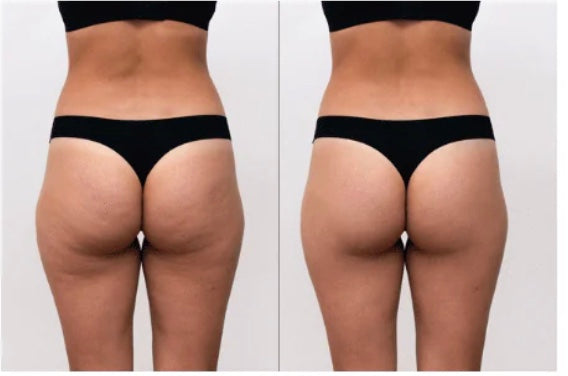 Serena – Figurformender Kompressions-Body