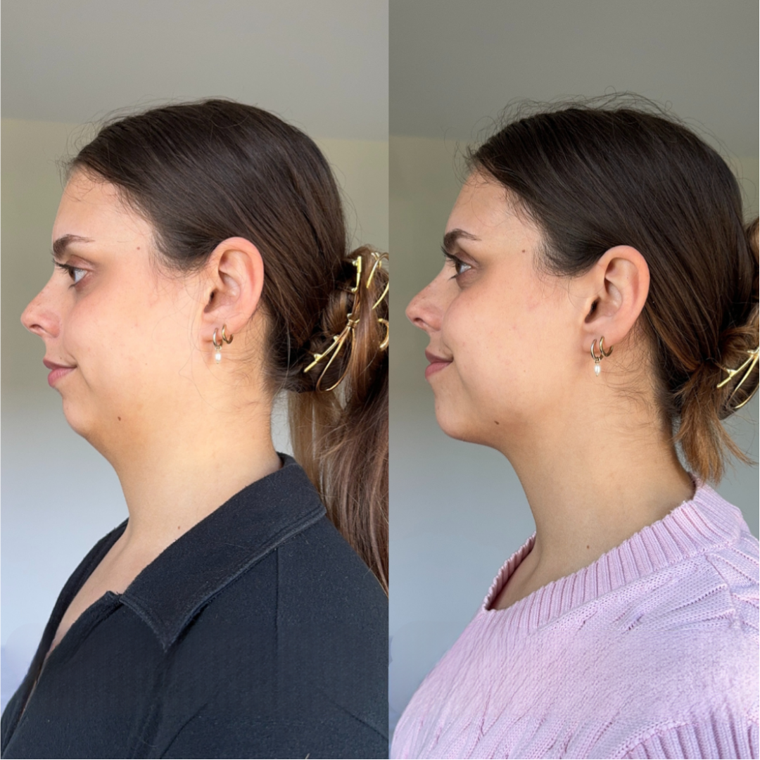 Naya – V-Line Lifting Band mit Nano-Hydrogel