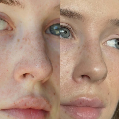 Luniva Pore Purifier – Verkleinert Nasenporen und absorbiert überschüssigen Talg. AKTION: 2 Packungen kaufen = 1 gratis dazu!
