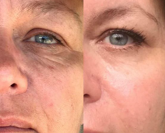 Nami – Koreanische Microneedle Augenpatches für Feuchtigkeit & Straffung